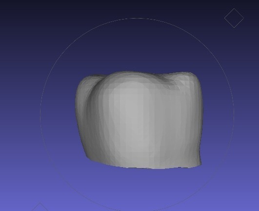 牙冠3D打印模型